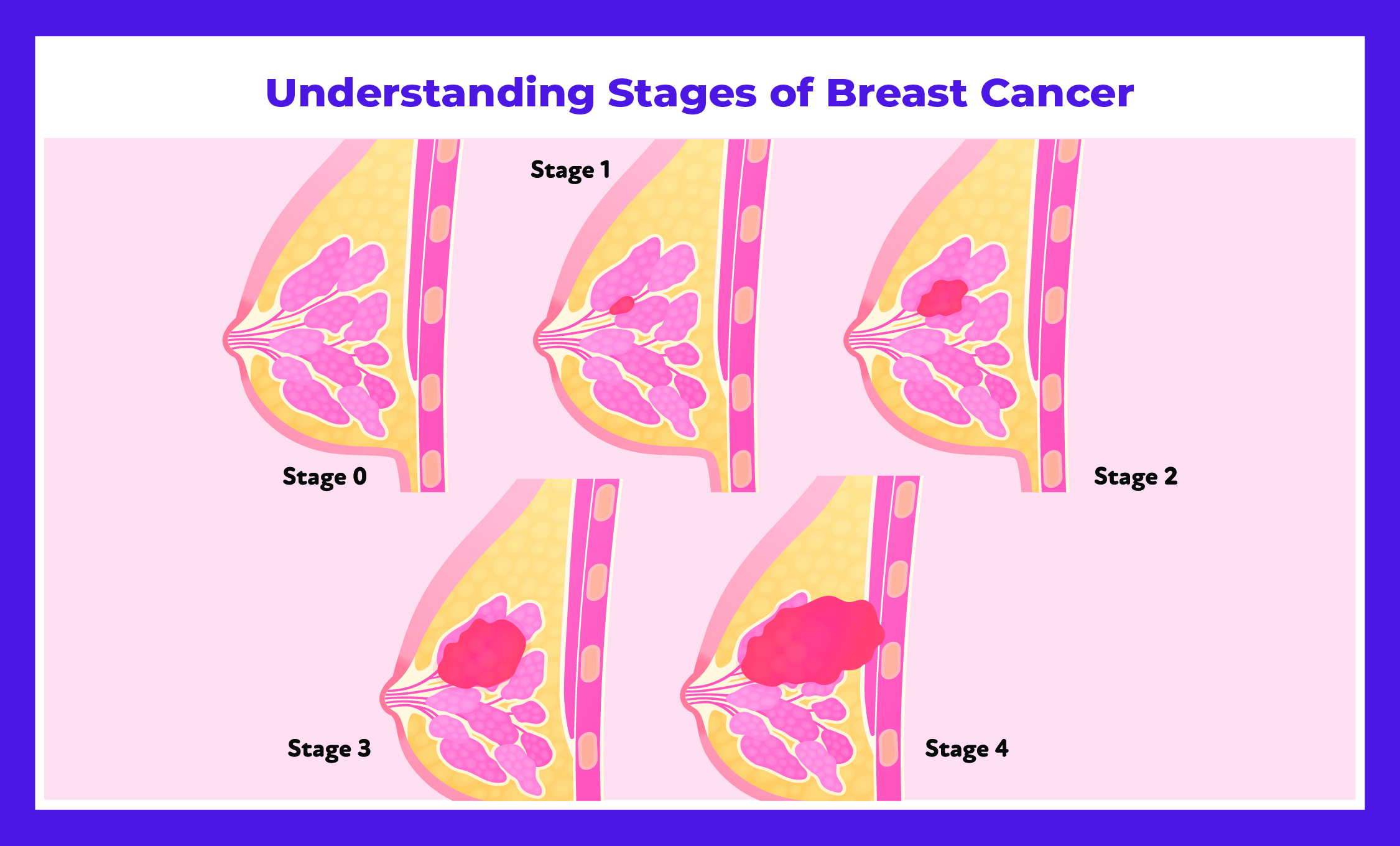 Understanding the Stages of Breast Cancer | Insights by Dr. Deepak Jha