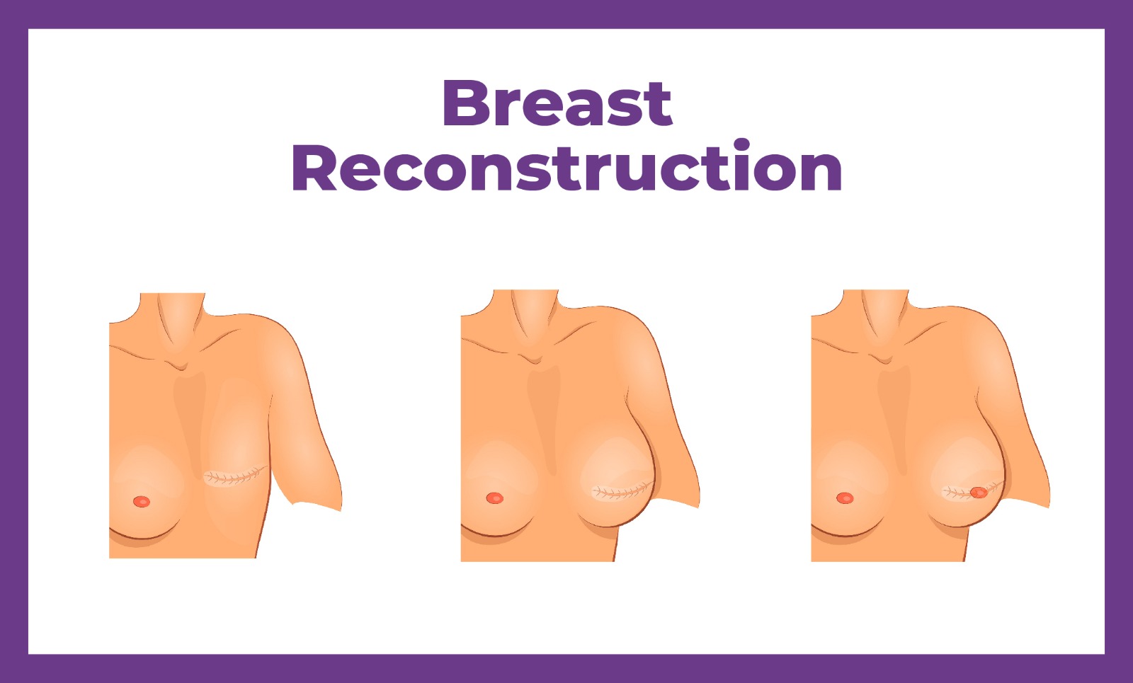 Breast Reconstruction