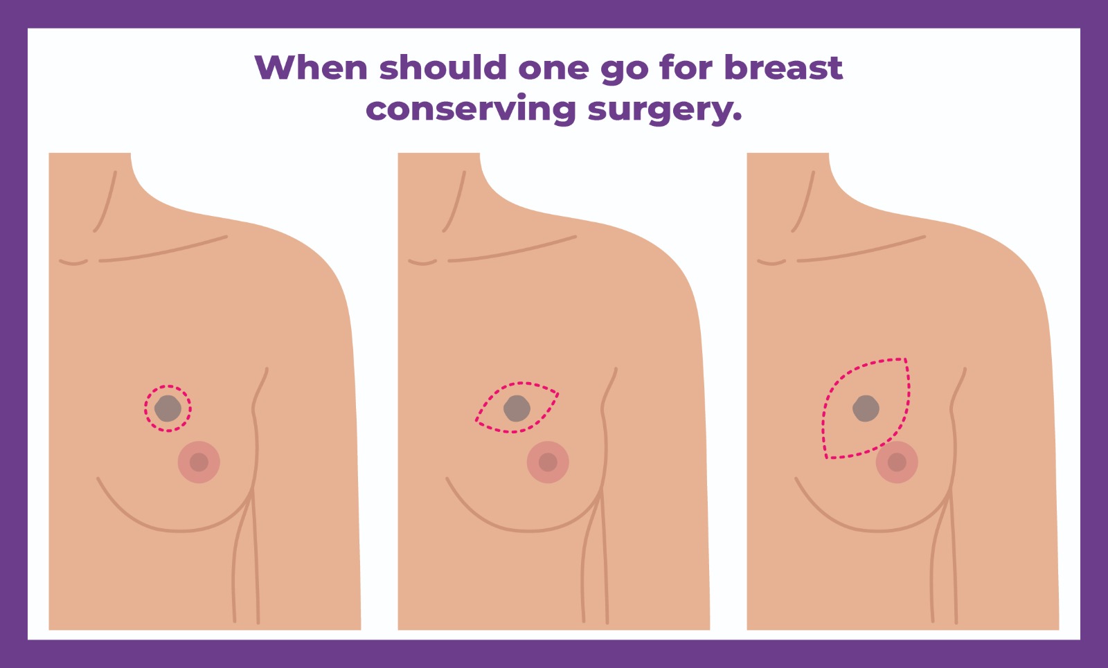 Breast Conserving Surgery vs Mastectomy | Which One is Right for You?