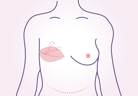 breast reconstruction using your own fat