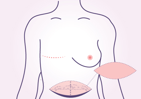 diep free flap breast reconstruction
