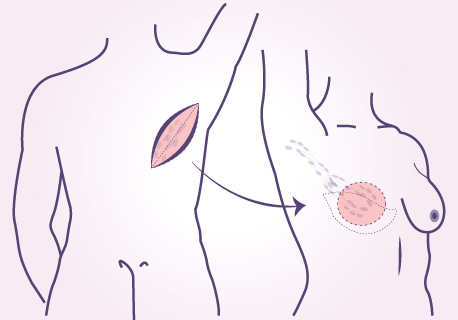 Latissimus Dorsi Flap