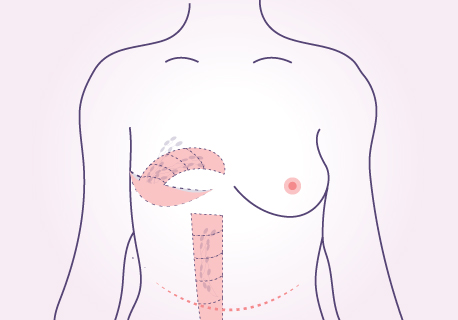 tram breast reconstruction